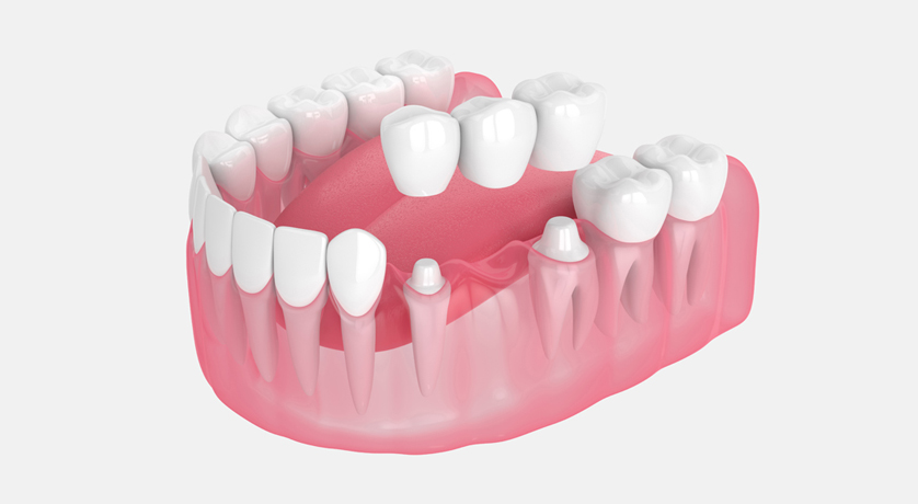 Dental Bridges