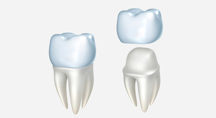 Dental Crowns