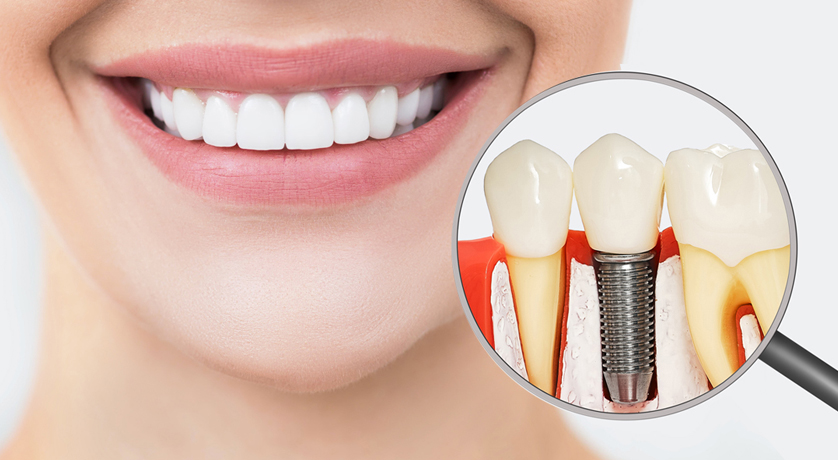 Dental Implants