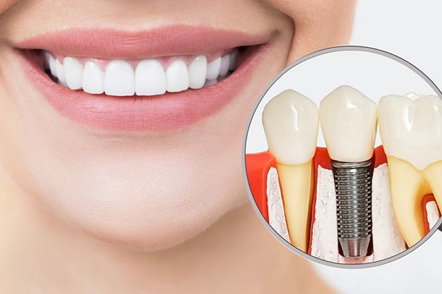 Dental Implants